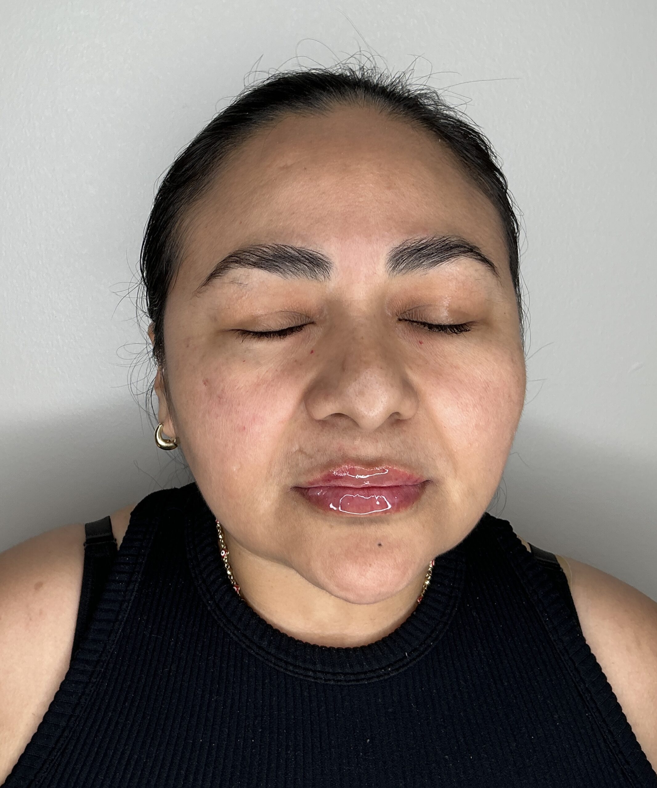 Lip filler, Aesthetic Beauty Lab Apple Valley MN