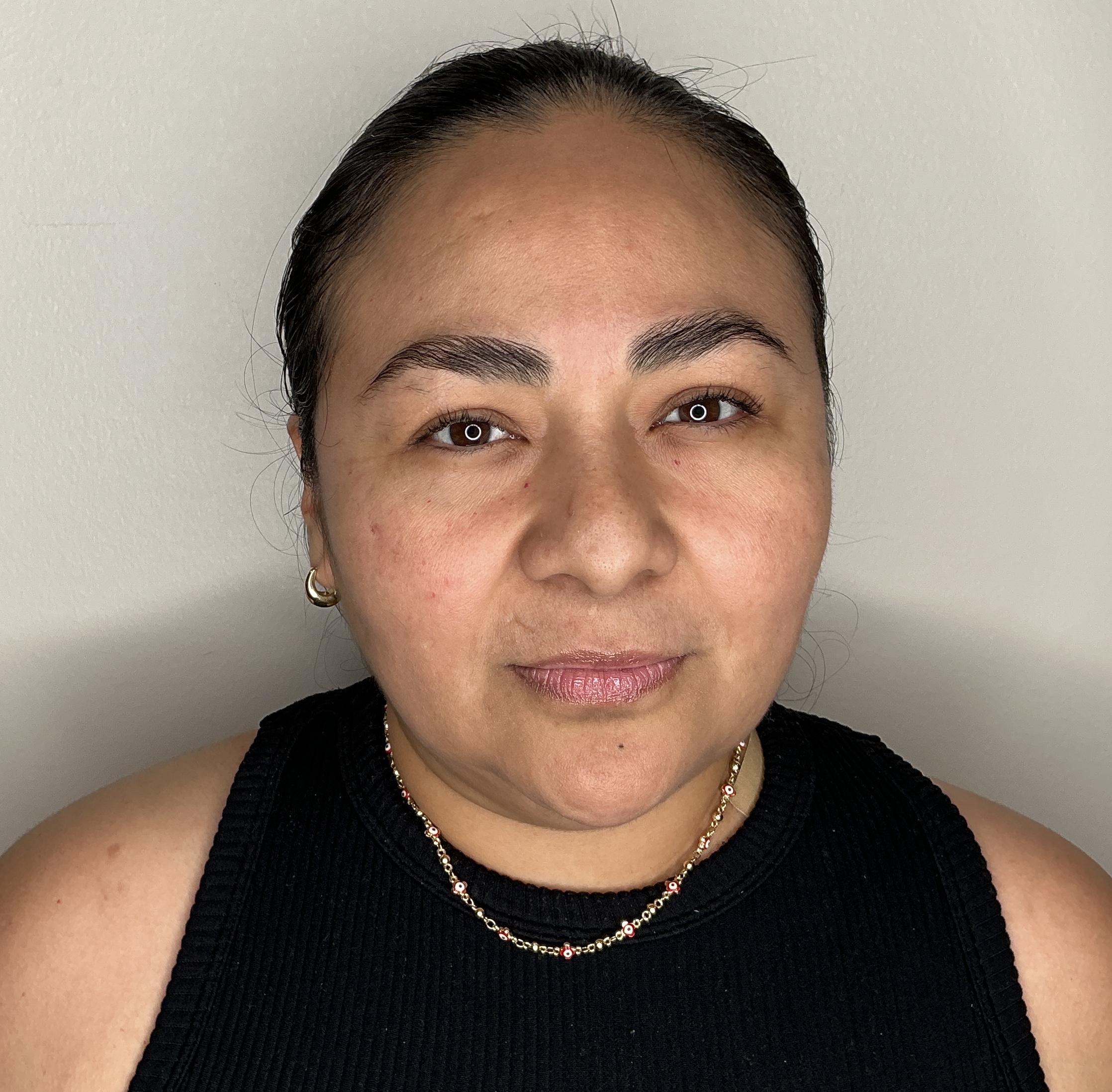 Lip filler, Aesthetic Beauty Lab Apple Valley MN