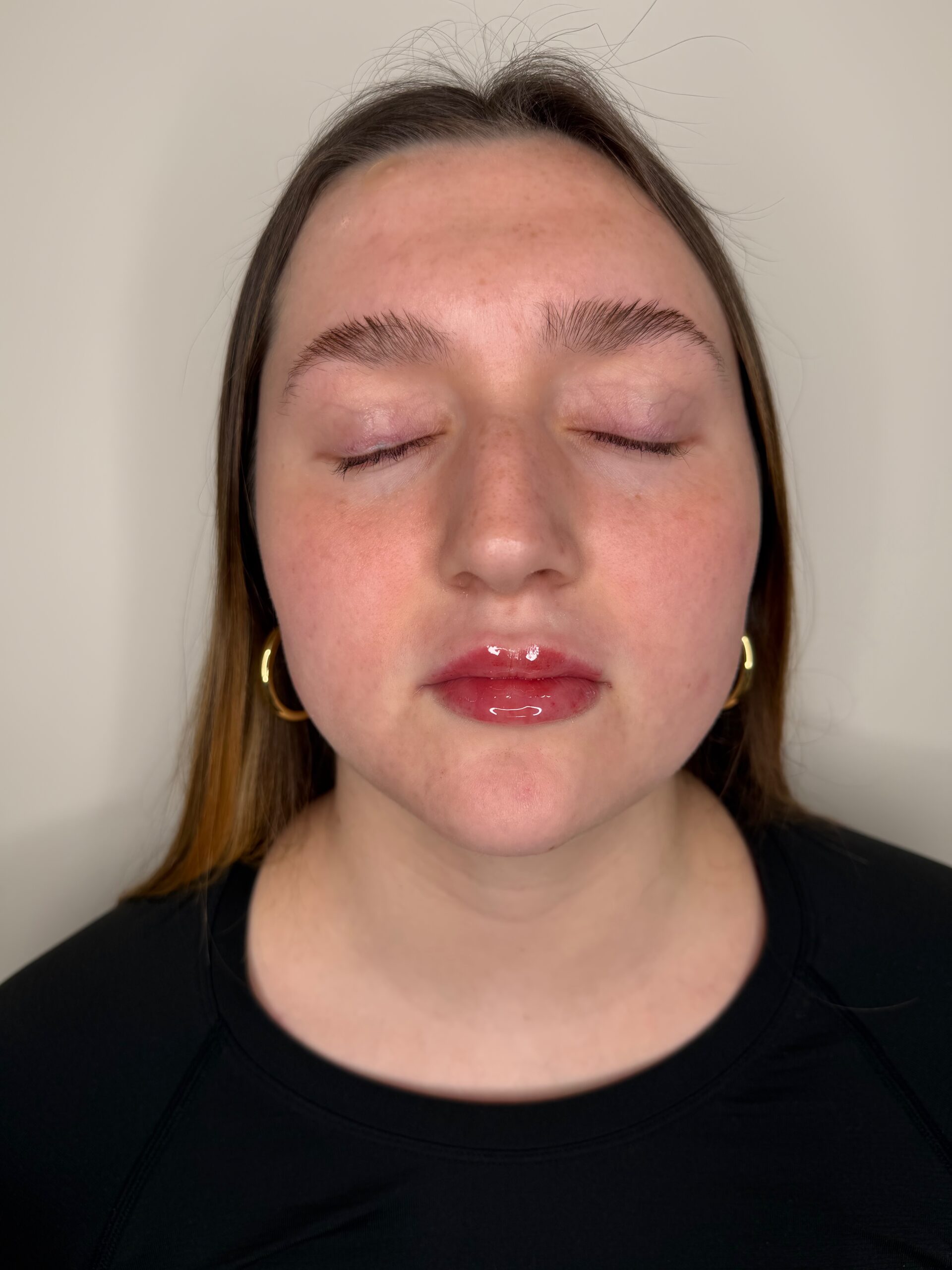 Lip filler at Aesthetic Beauty Lab Apple Valley MN