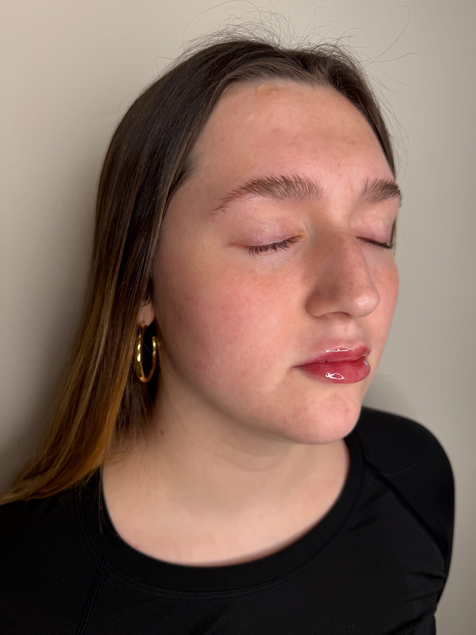Lip filler at Aesthetic Beauty Lab Apple Valley MN