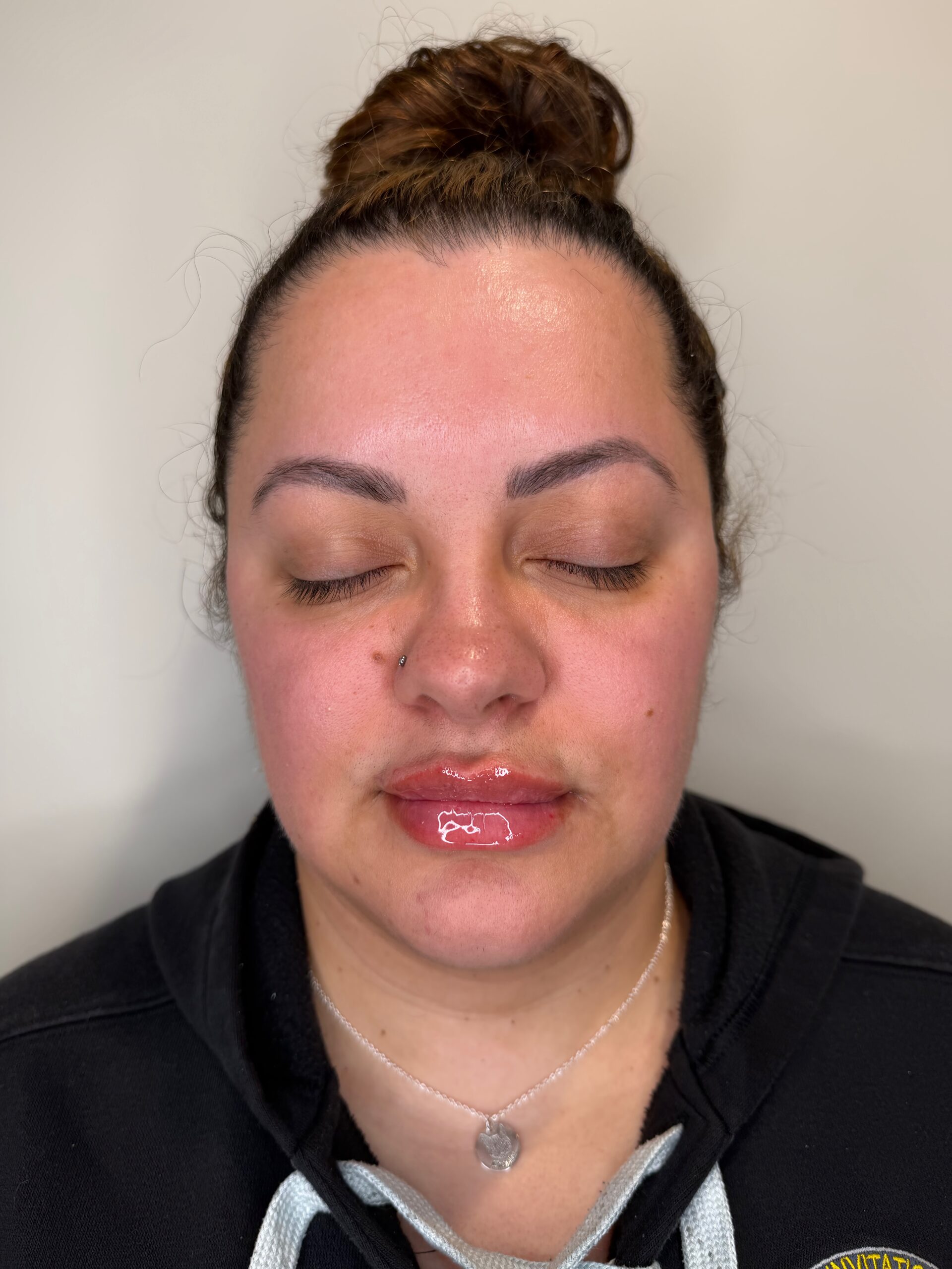 Lip filler at Aesthetic Beauty Lab Apple Valley MN