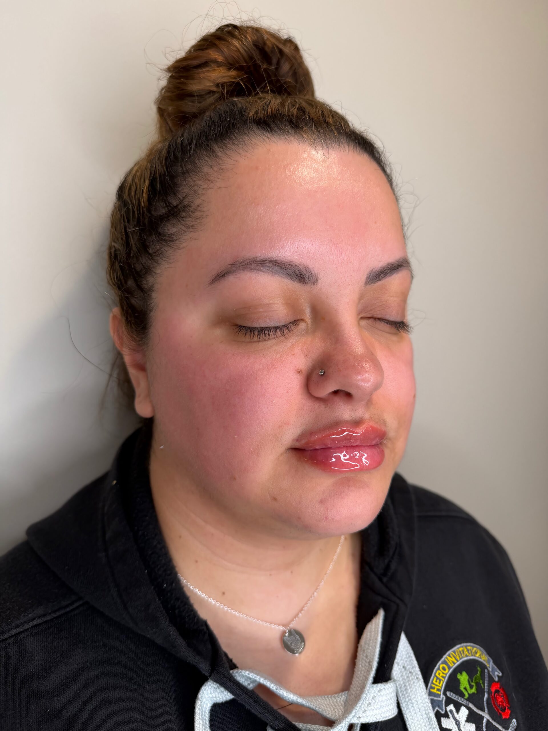 Lip filler at Aesthetic Beauty Lab Apple Valley MN