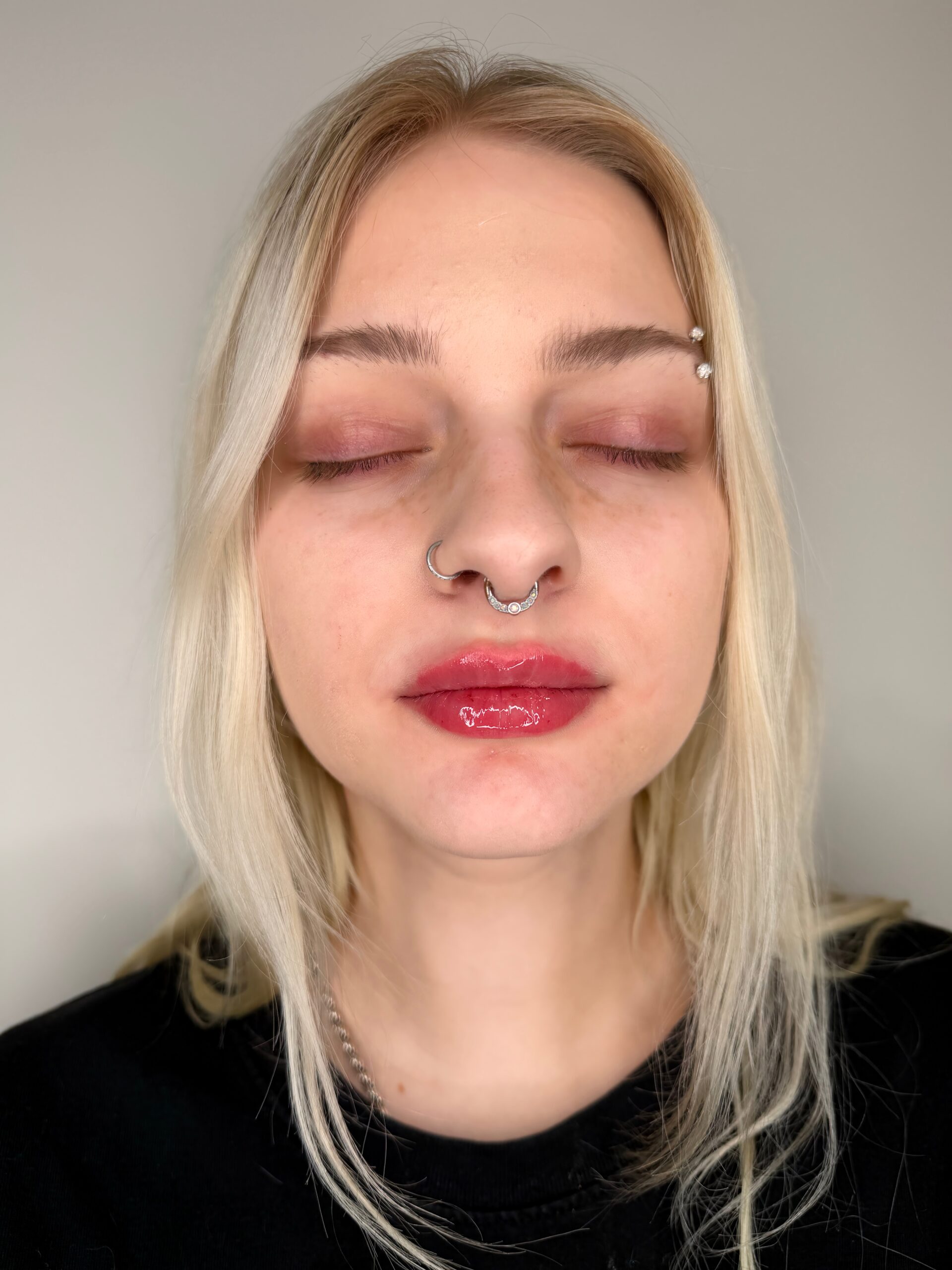 Lip filler at Aesthetic Beauty Lab Apple Valley MN