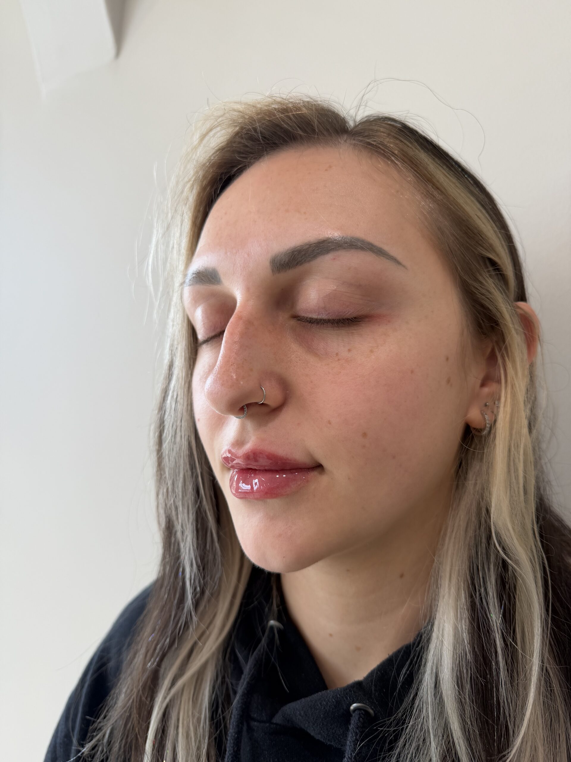 Lip filler at Aesthetic Beauty Lab Apple Valley MN