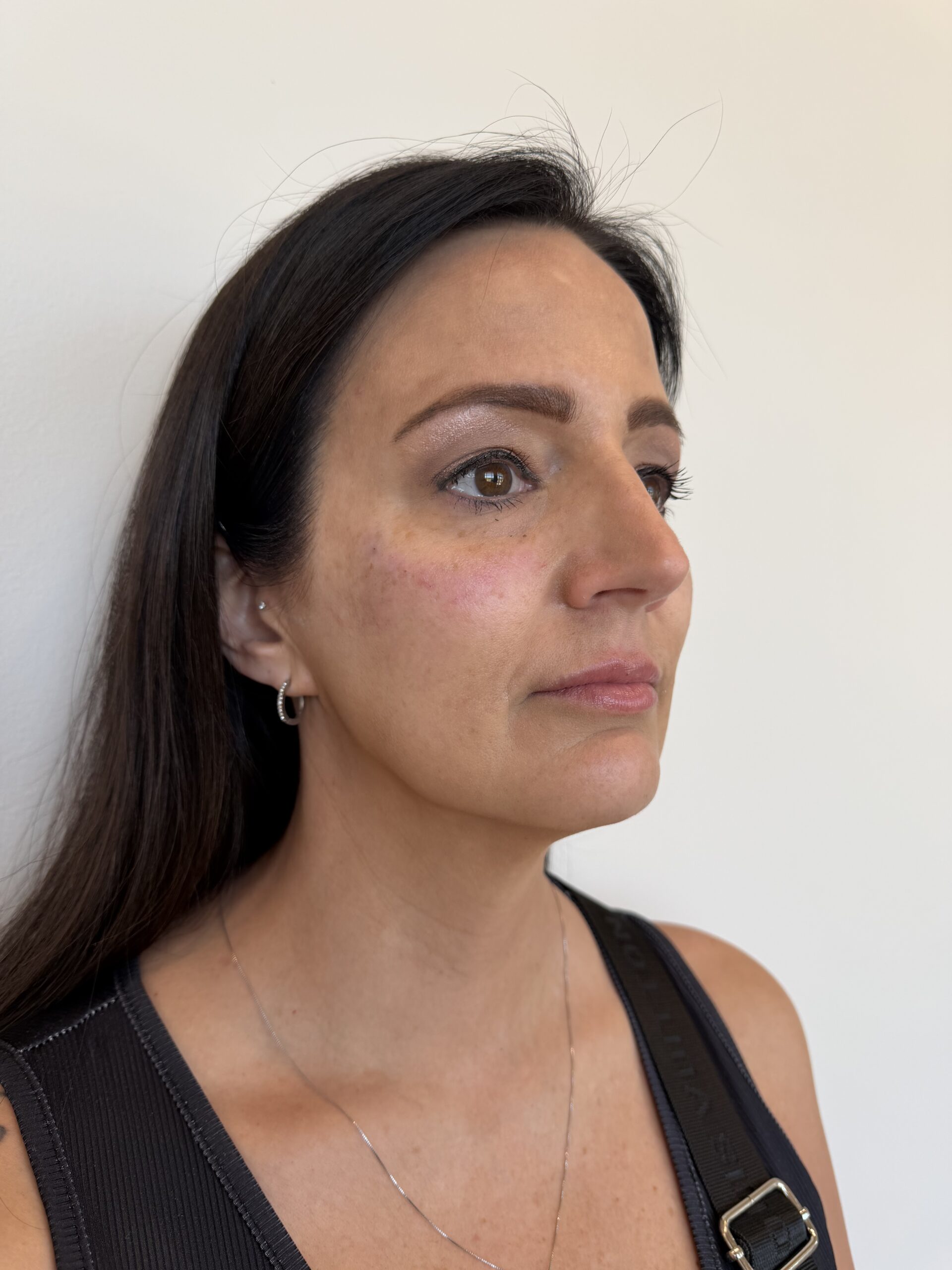 Cheek filler at Aesthetic Beauty Lab Apple Valley MN