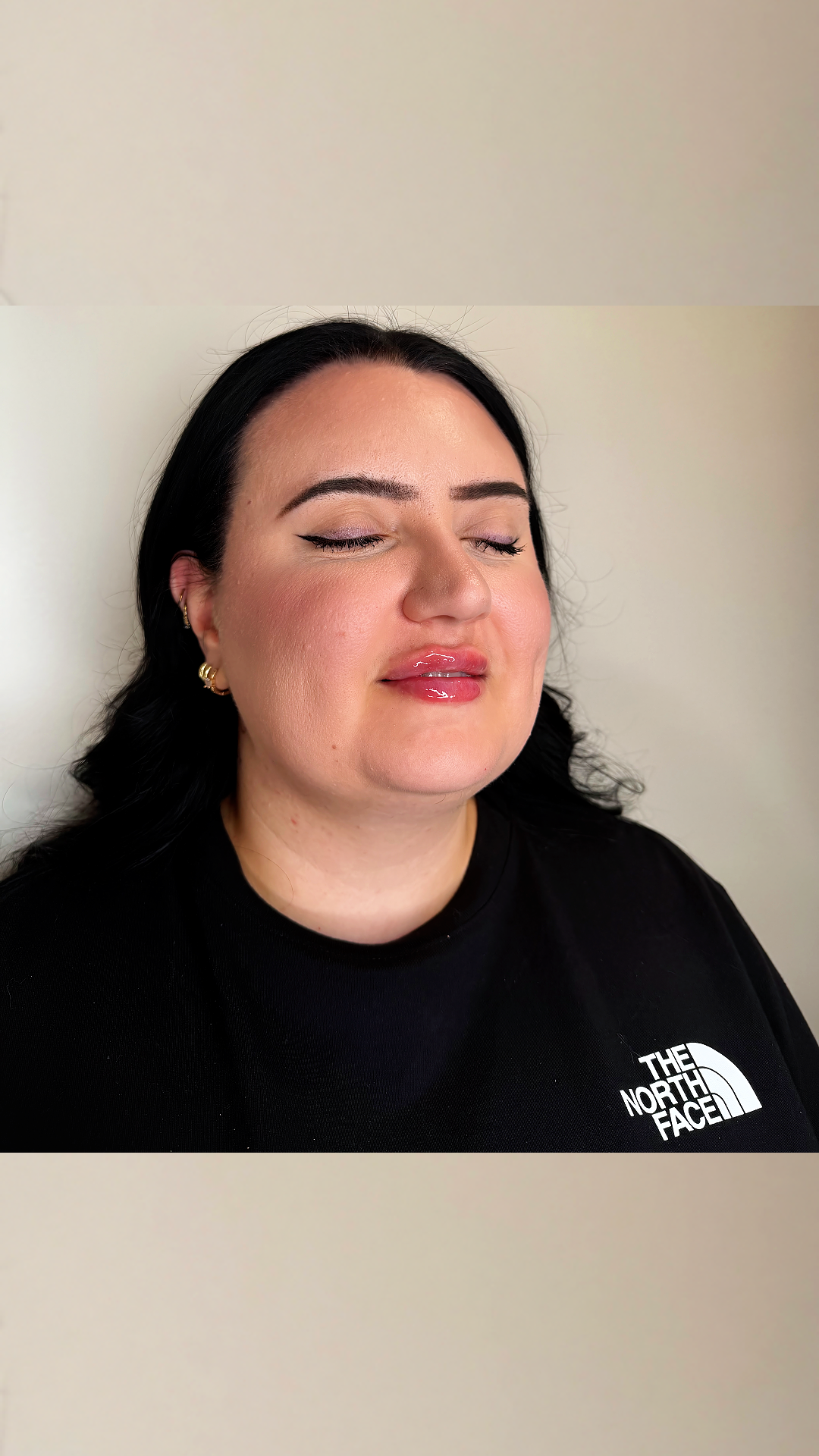 Lip filler at Aesthetic Beauty Lab Apple Valley MN
