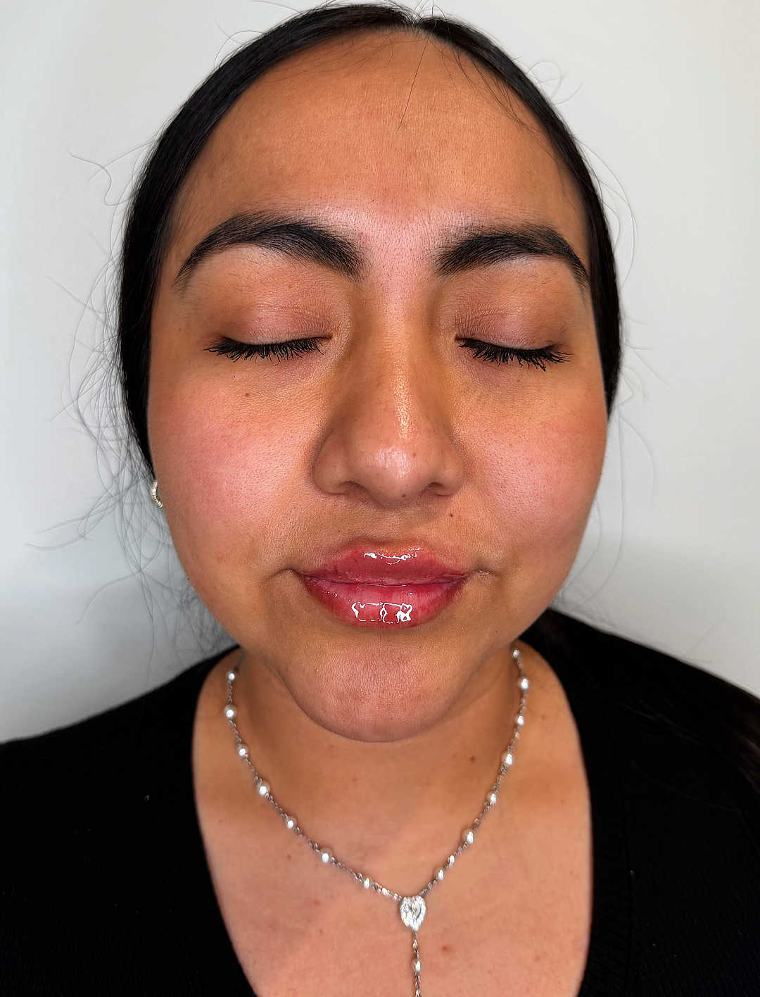 Lip filler at Aesthetic Beauty Lab Apple Valley MN