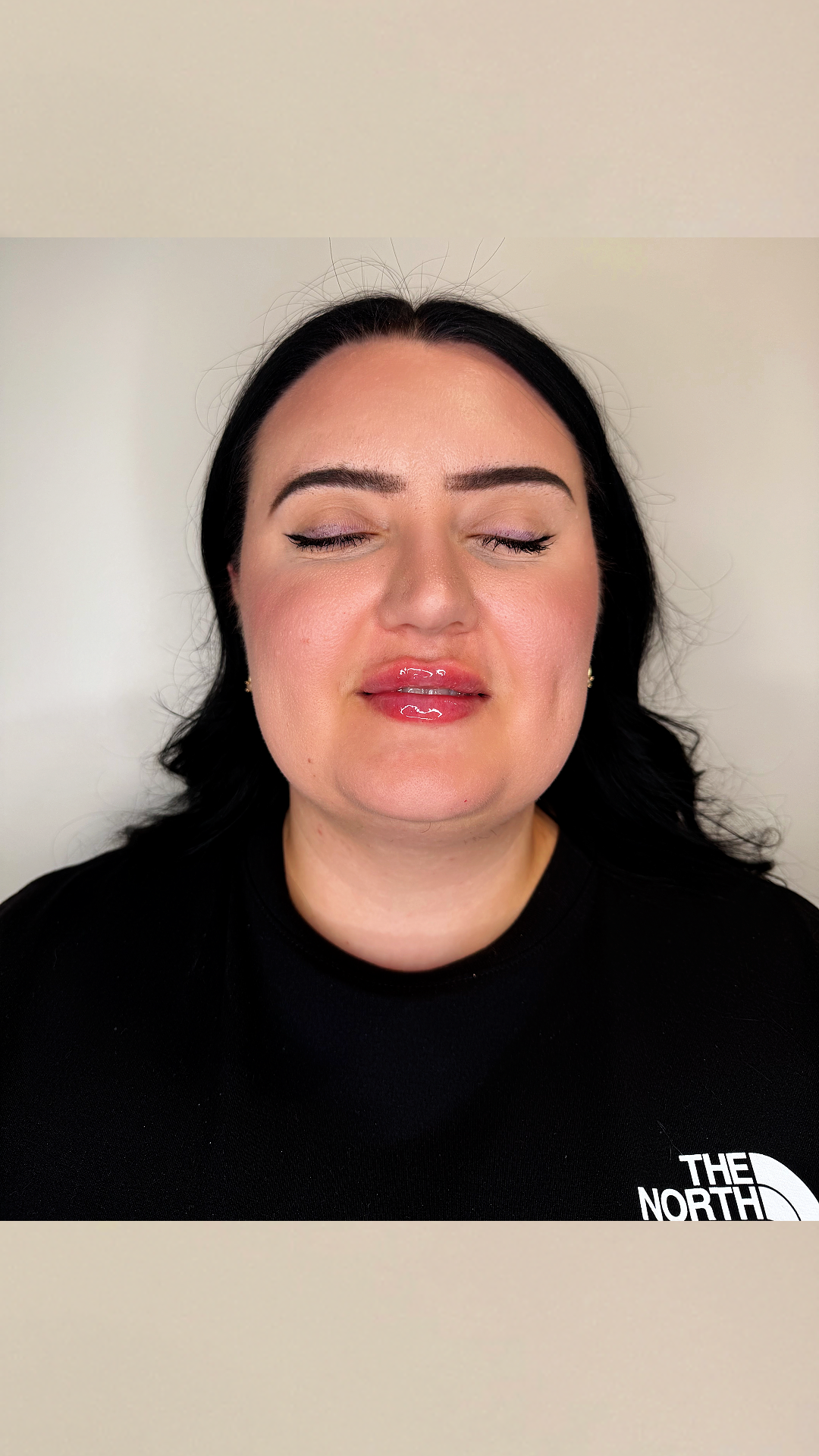 Lip filler at Aesthetic Beauty Lab Apple Valley MN