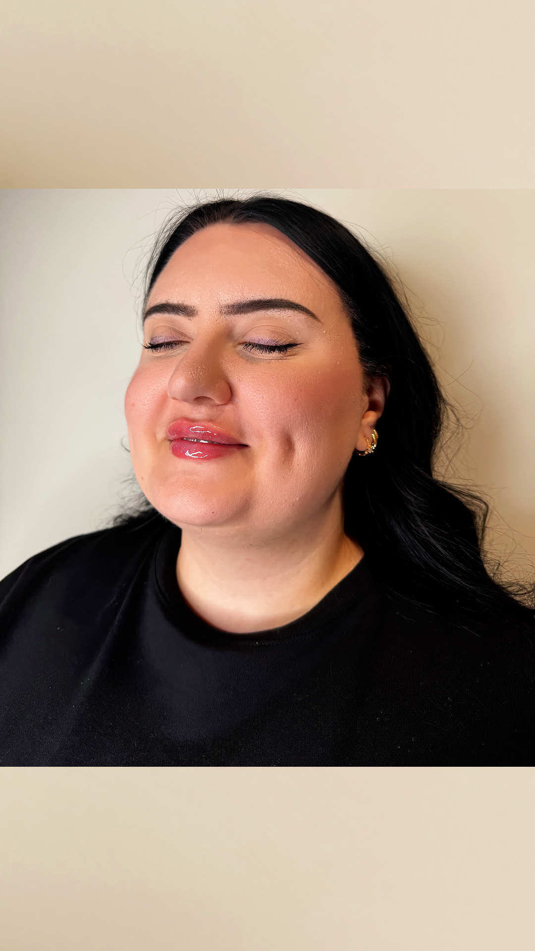 Lip filler at Aesthetic Beauty Lab Apple Valley MN