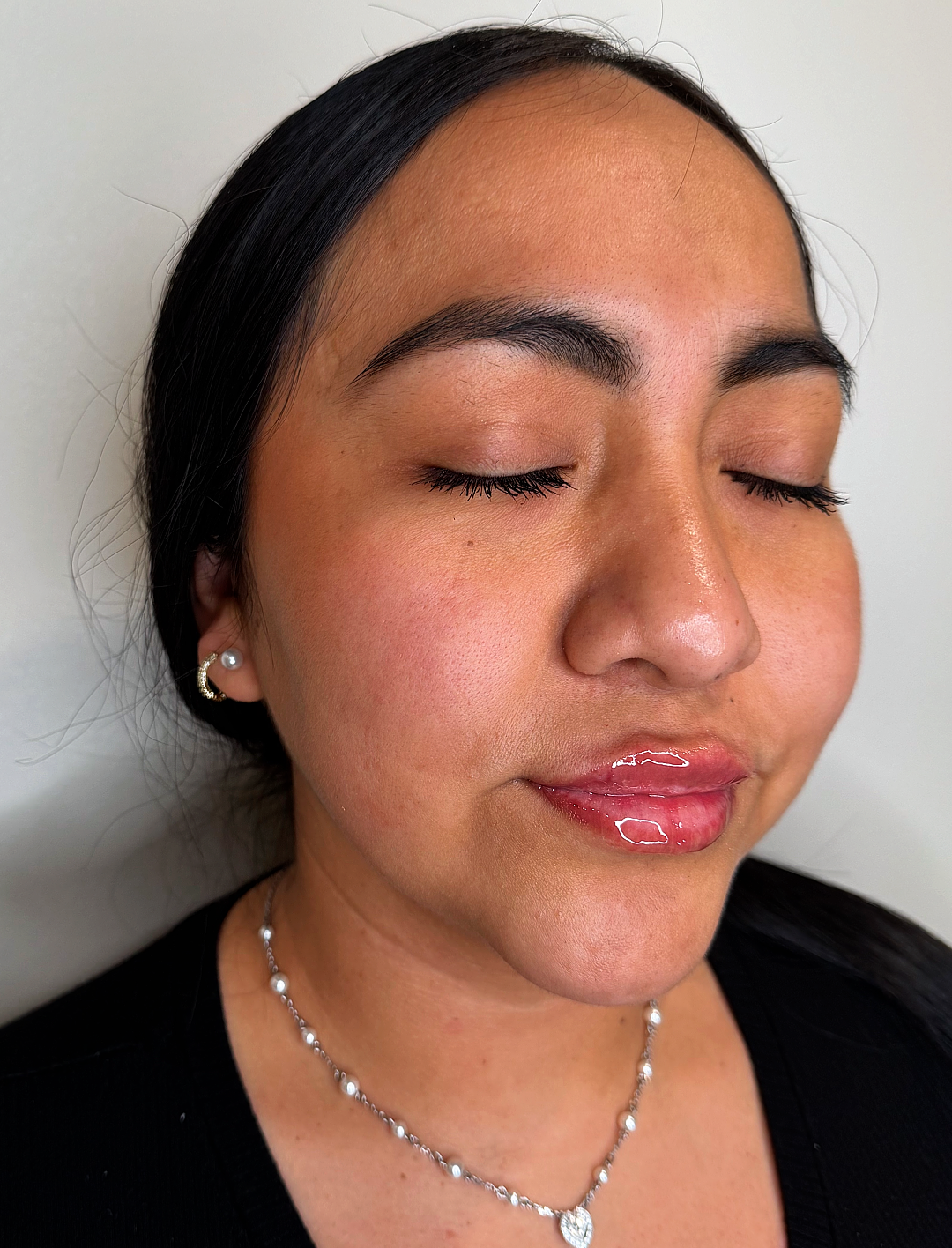 Lip filler at Aesthetic Beauty Lab Apple Valley MN