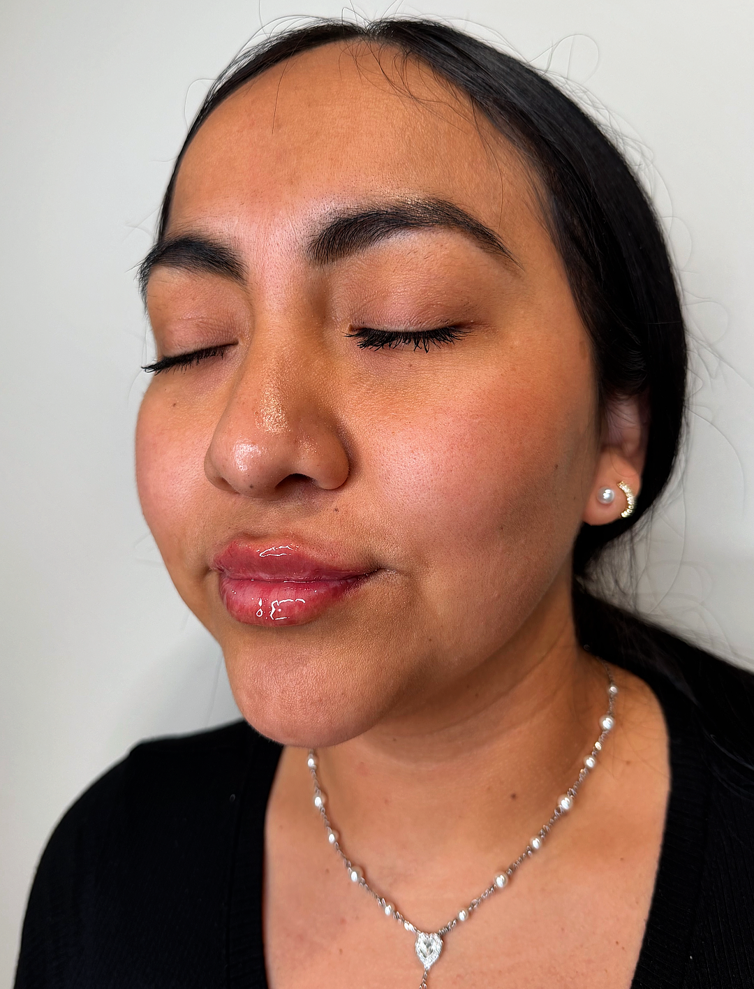 Lip filler at Aesthetic Beauty Lab Apple Valley MN