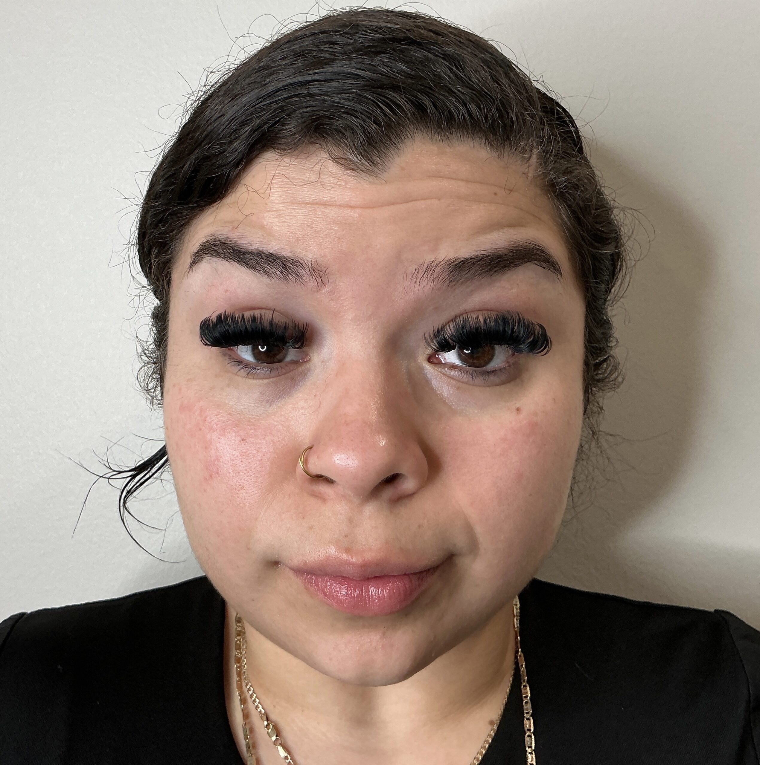 Botox forehead lines before at Aesthetic Beauty Lab Apple Valley MN