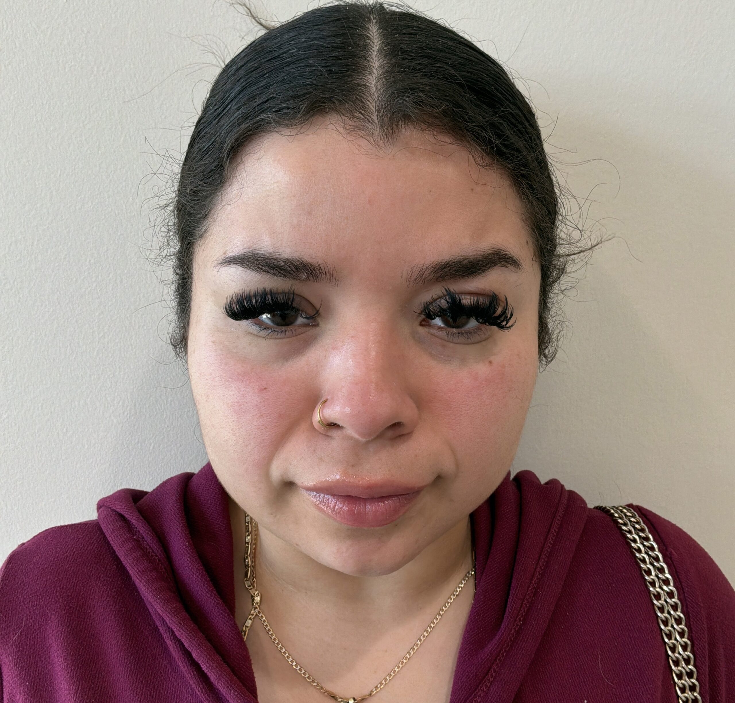 Botox glabella 11s after at Aesthetic Beauty Lab Apple Valley MN