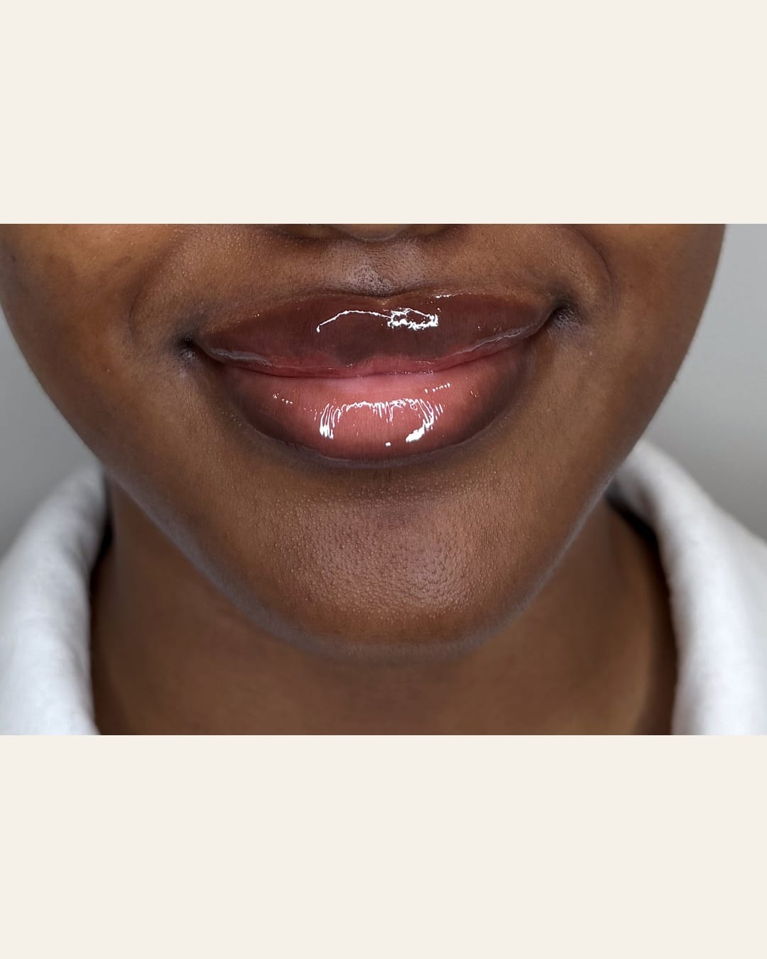 Lip filler at Aesthetic Beauty Lab Apple Valley MN