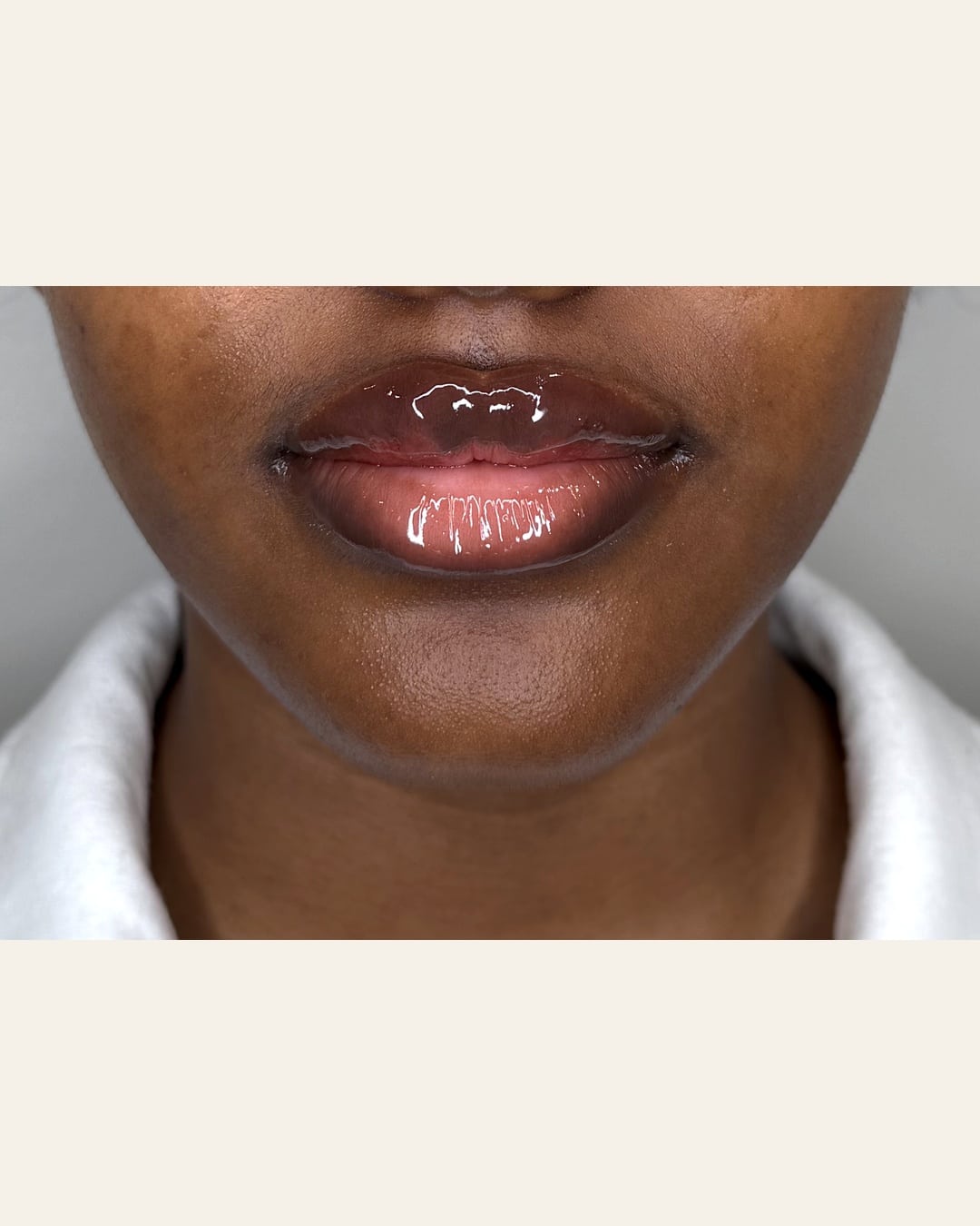 Lip filler at Aesthetic Beauty Lab Apple Valley MN