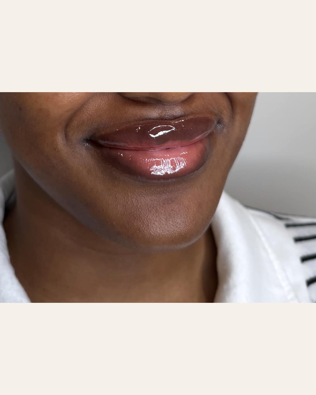 Lip filler at Aesthetic Beauty Lab Apple Valley MN