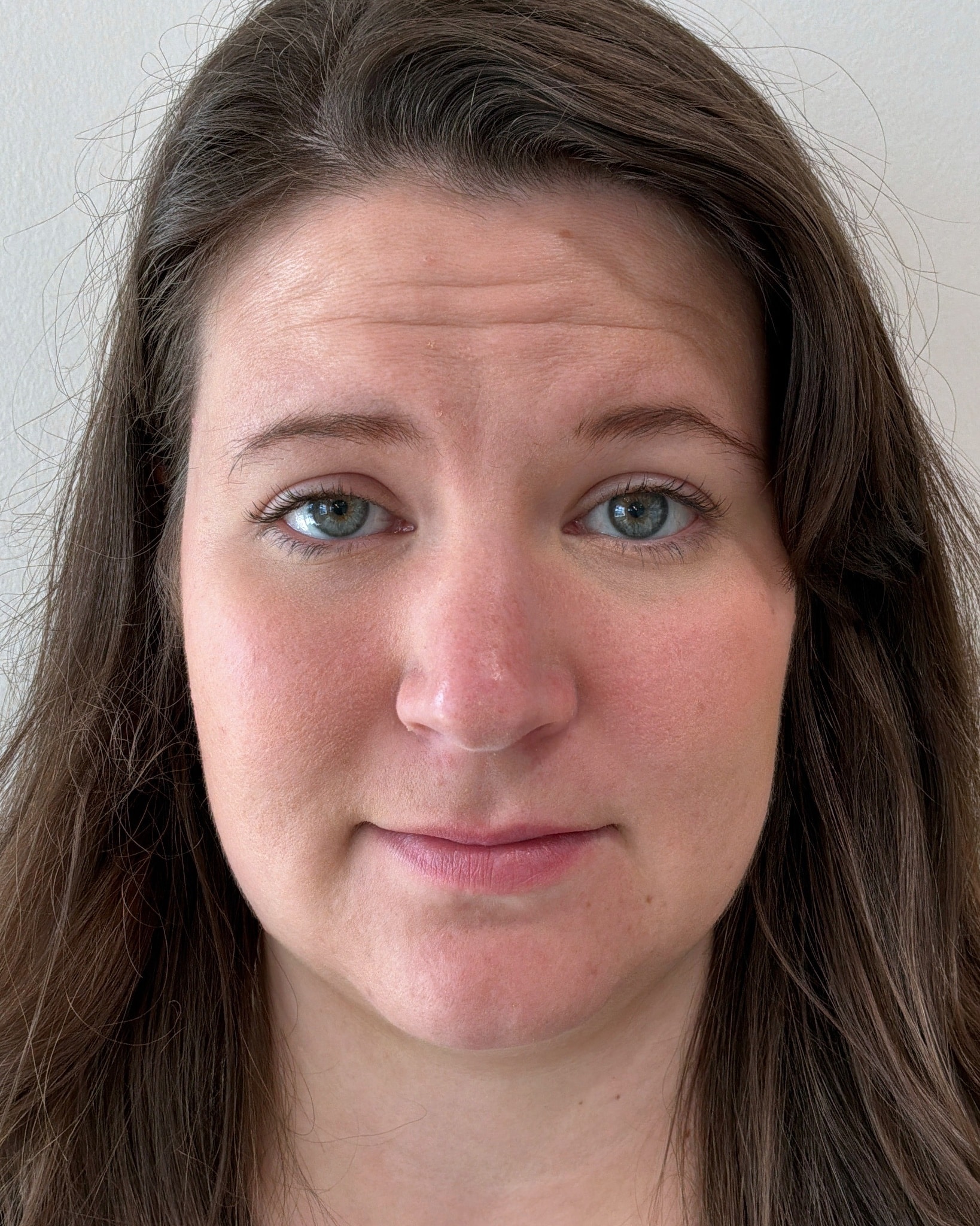 Botox forehead lines before at Aesthetic Beauty Lab Apple Valley MN