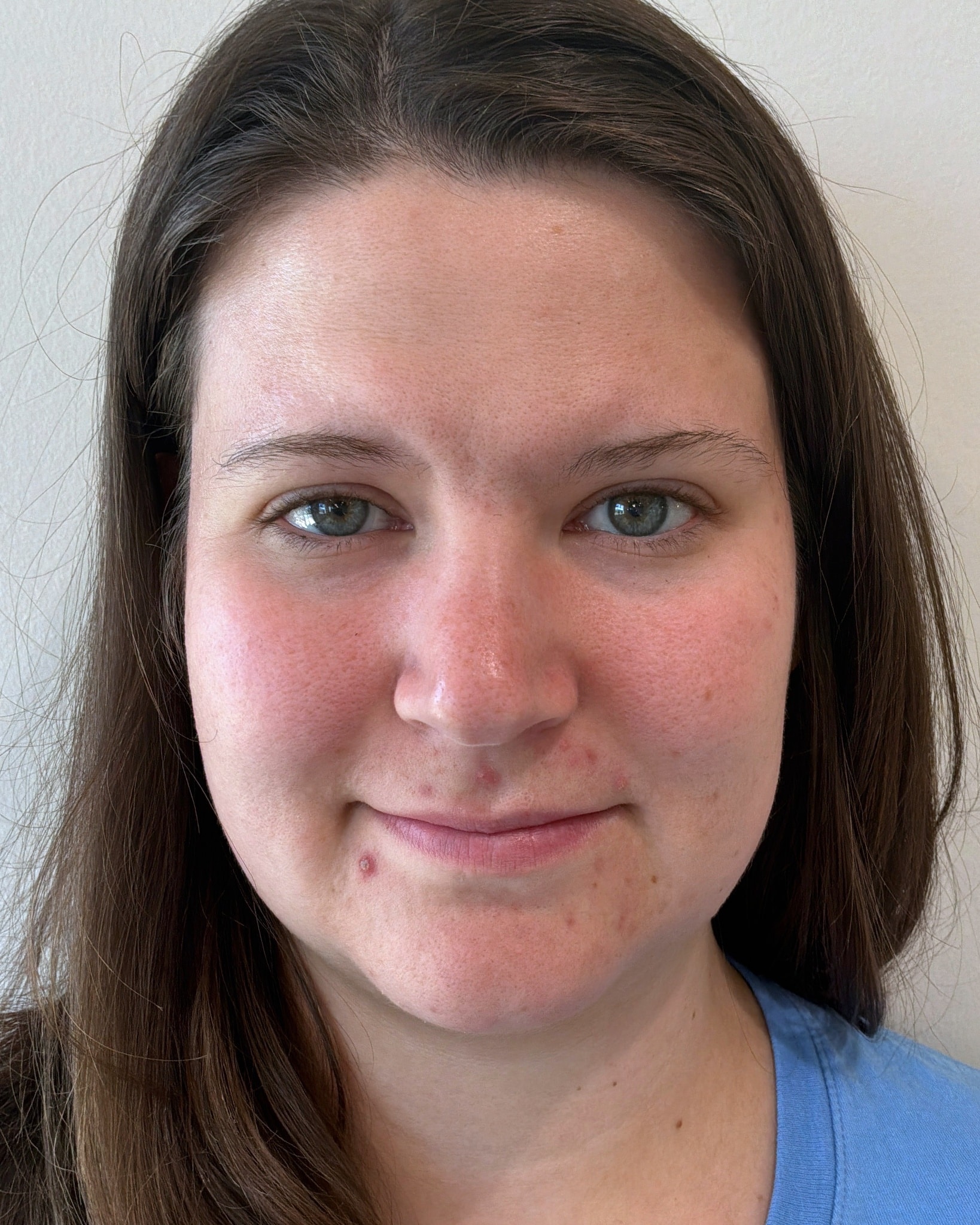 Botox forehead lines after at Aesthetic Beauty Lab Apple Valley MN