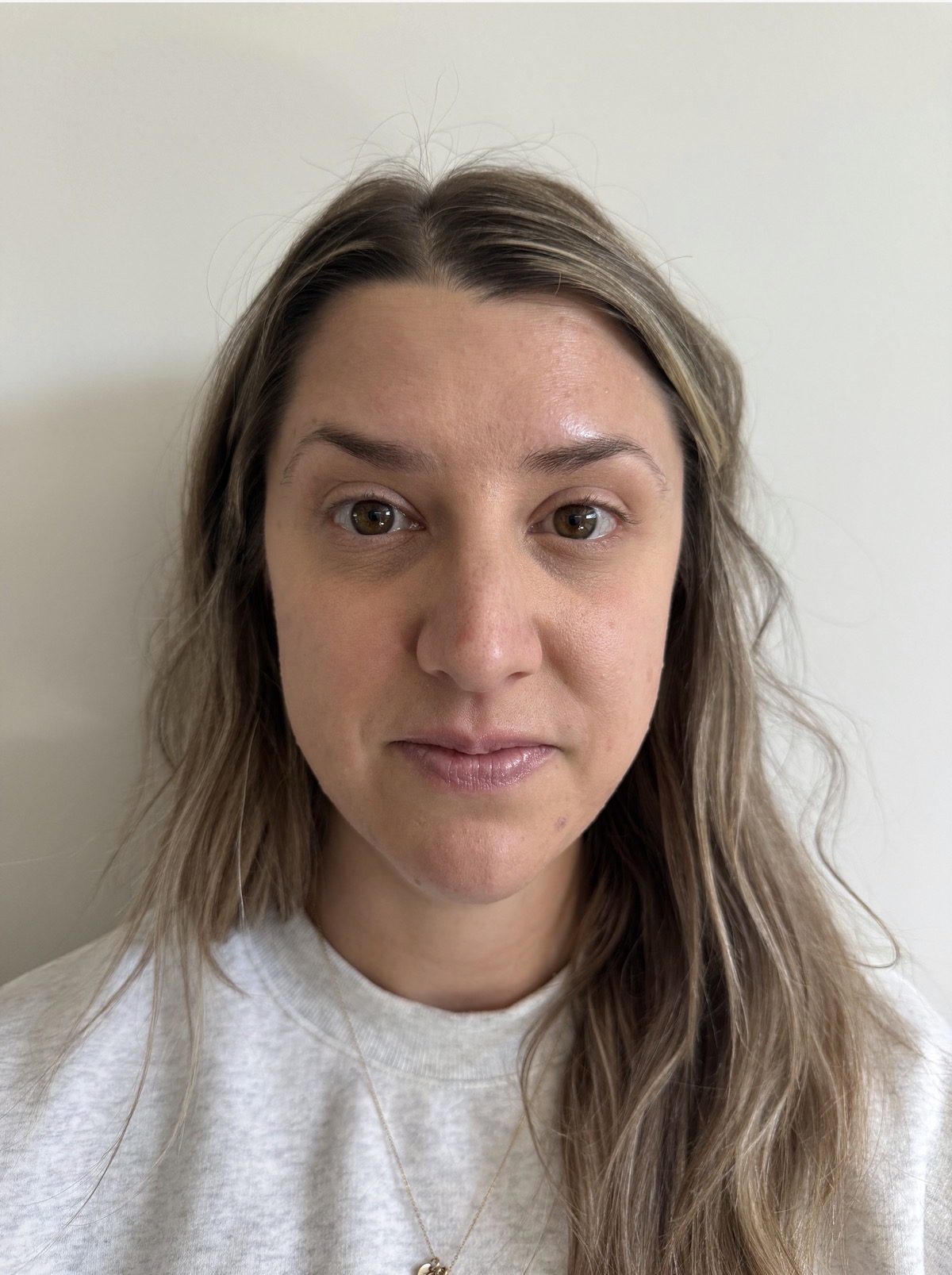 Botox forehead lines after at Aesthetic Beauty Lab Apple Valley MN