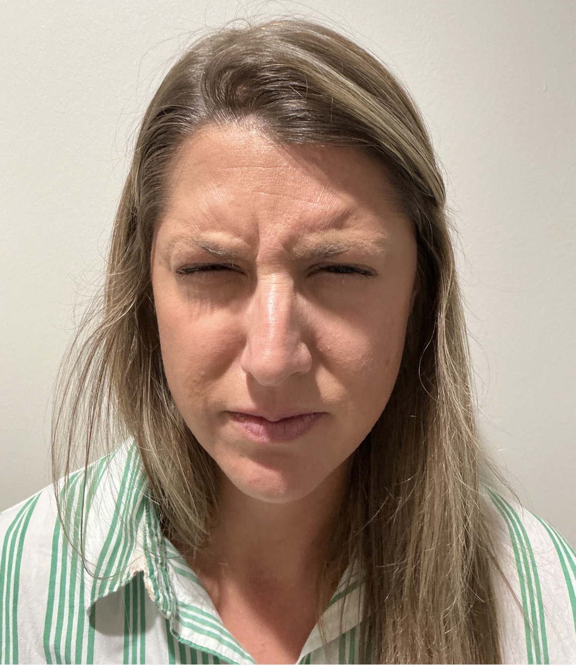 Botox glabella 11s before at Aesthetic Beauty Lab Apple Valley MN