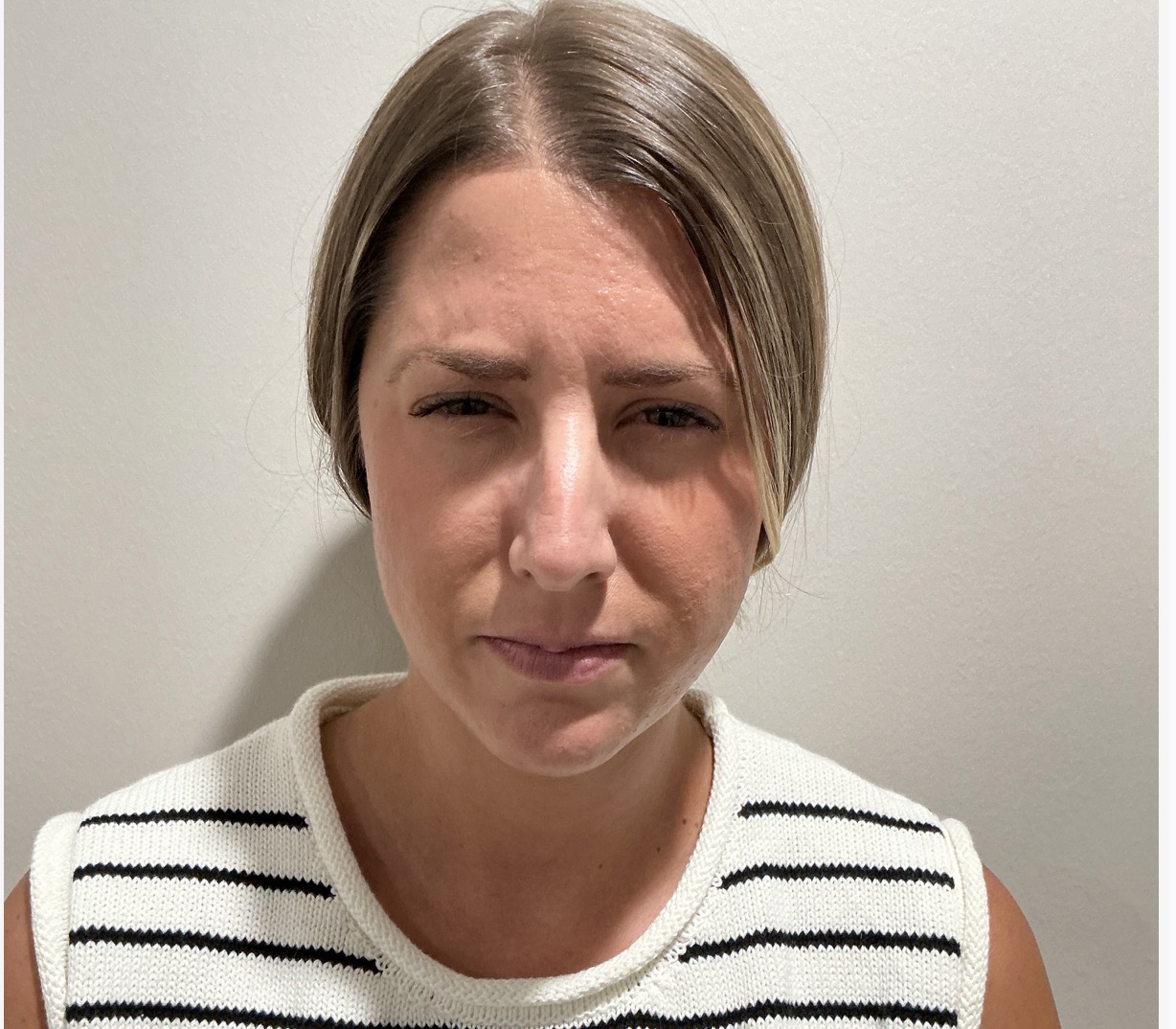 Botox glabella 11s after at Aesthetic Beauty Lab Apple Valley MN