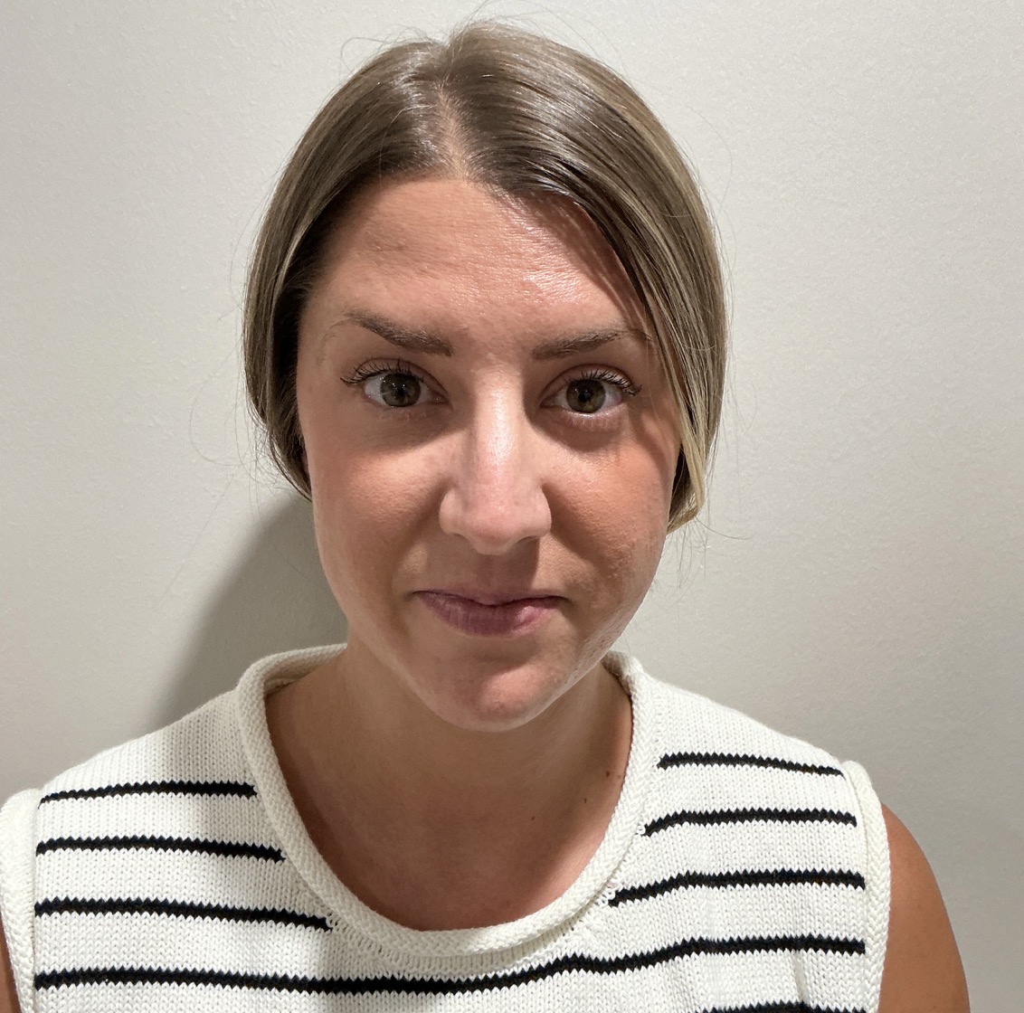 Botox forehead lines after at Aesthetic Beauty Lab Apple Valley MN