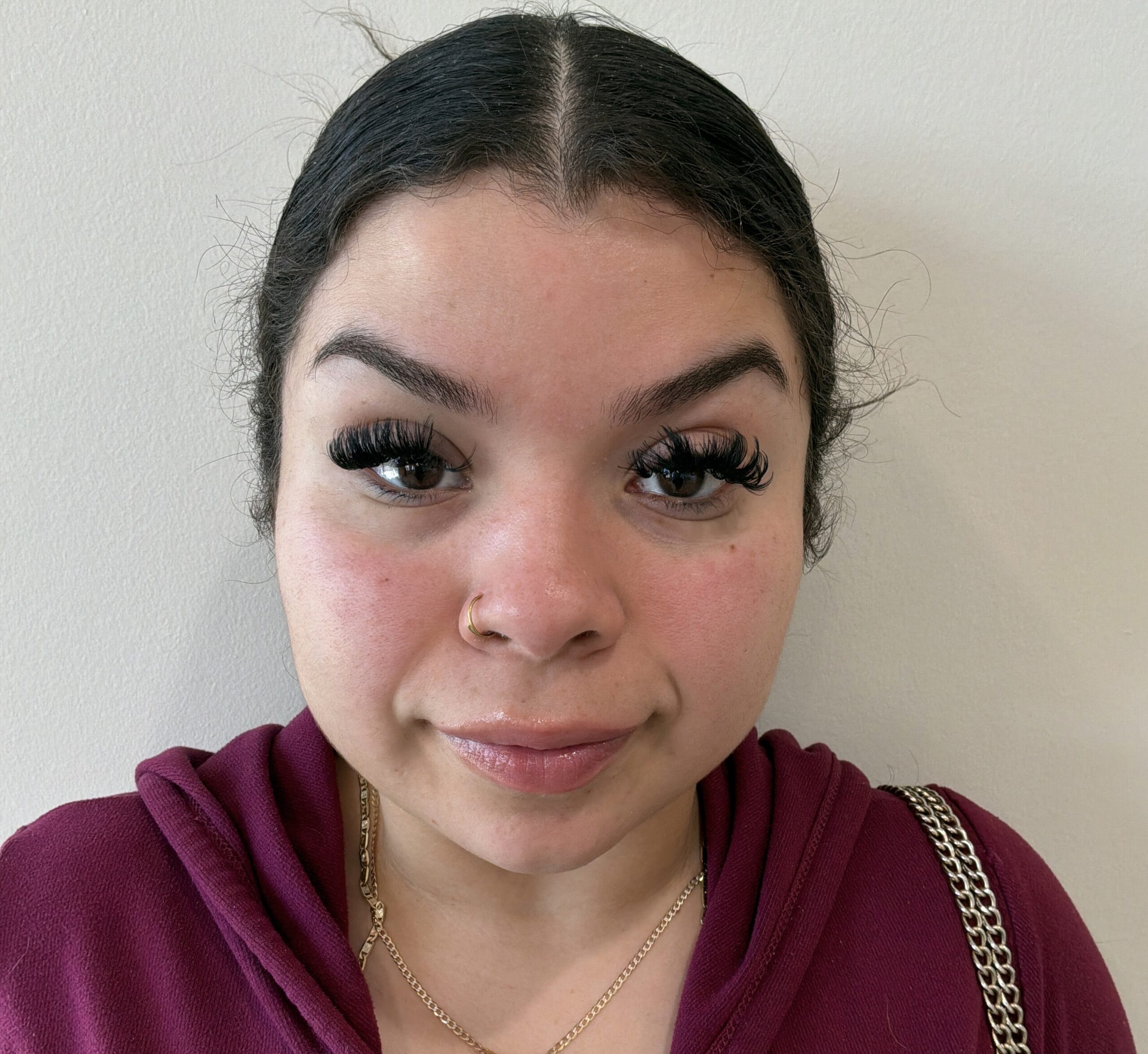 Botox forehead lines after at Aesthetic Beauty Lab Apple Valley MN
