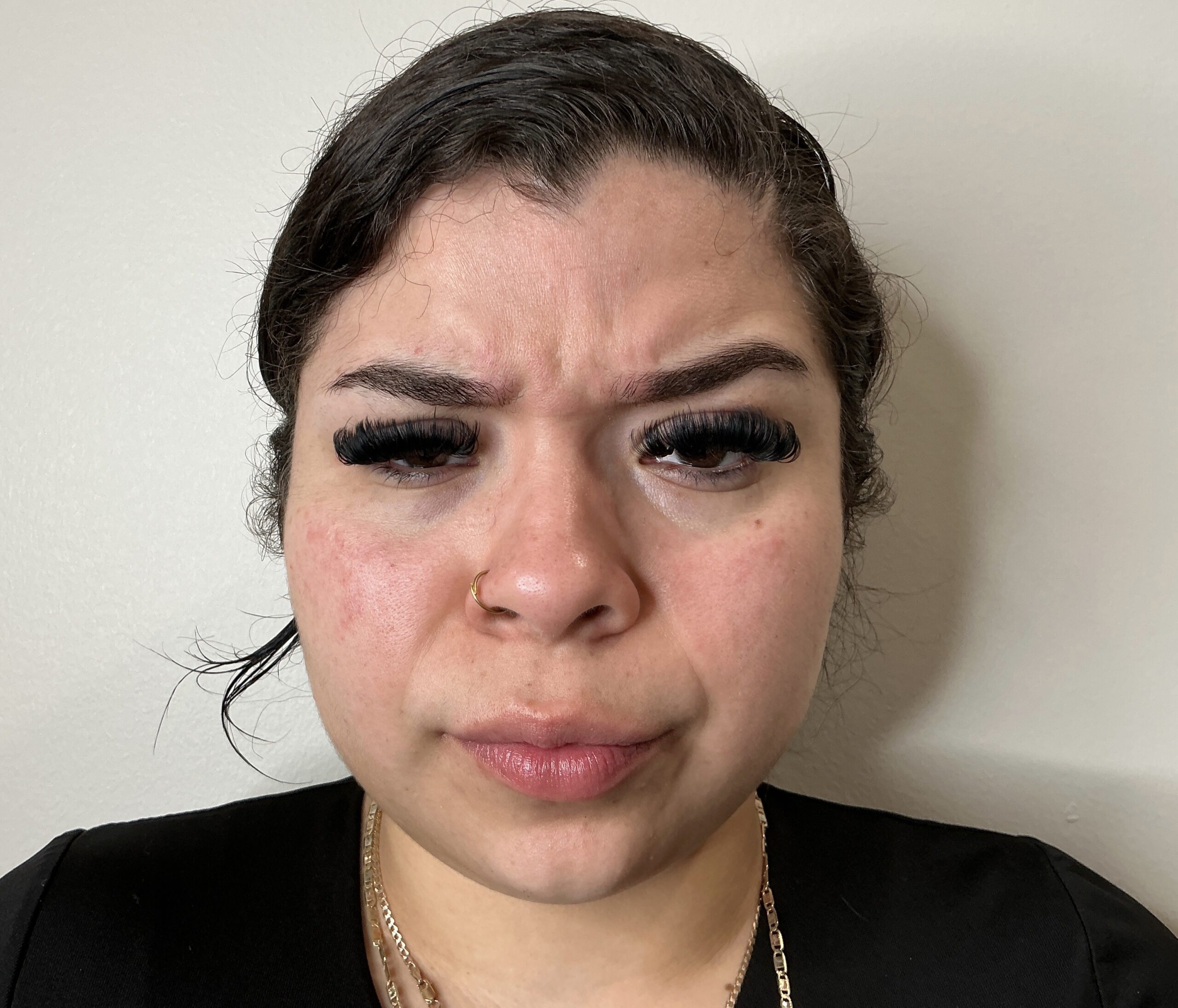 Botox glabella 11s before at Aesthetic Beauty Lab Apple Valley MN