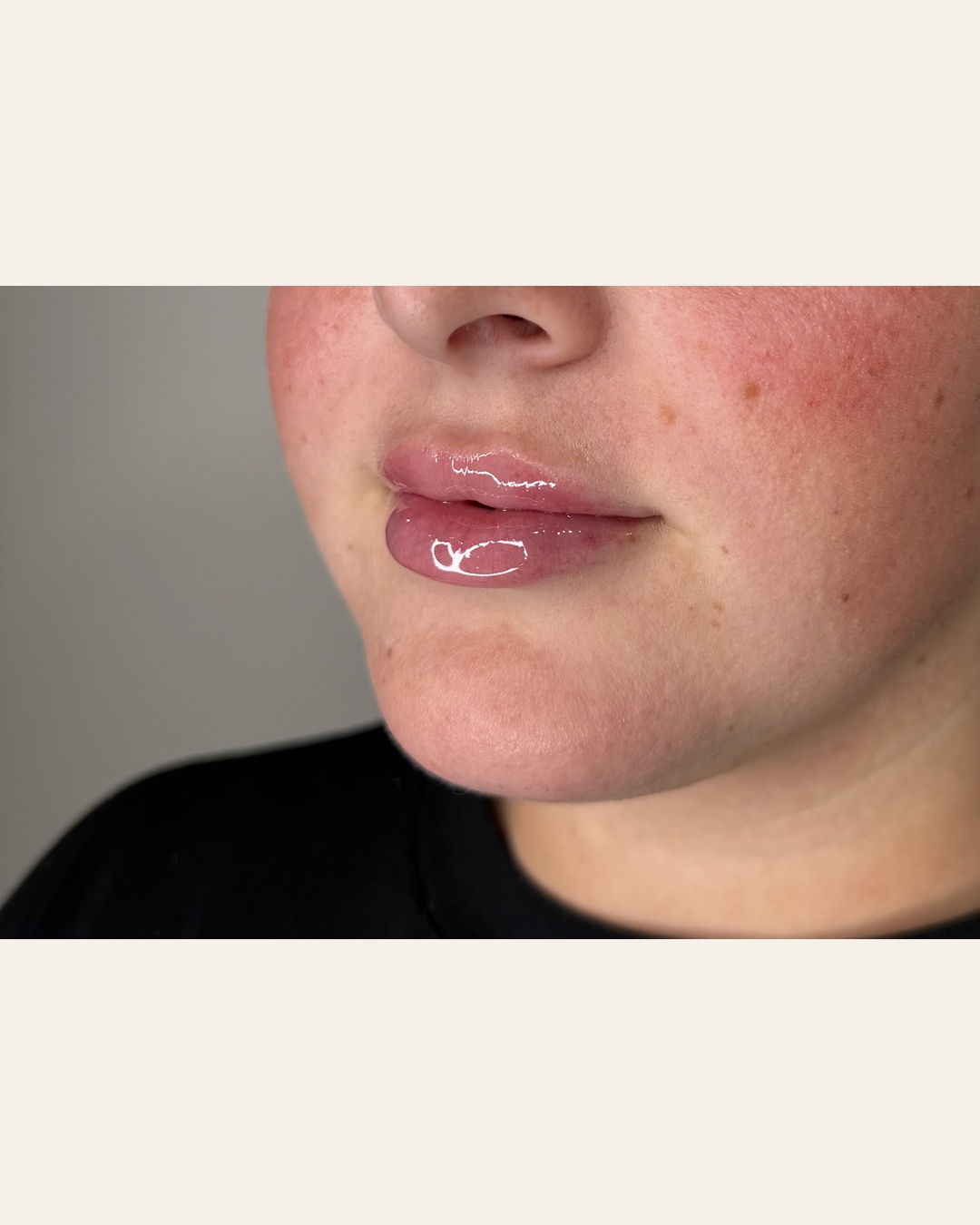Lip filler result three-quarter view at Aesthetic Beauty Lab, Apple Valley MN