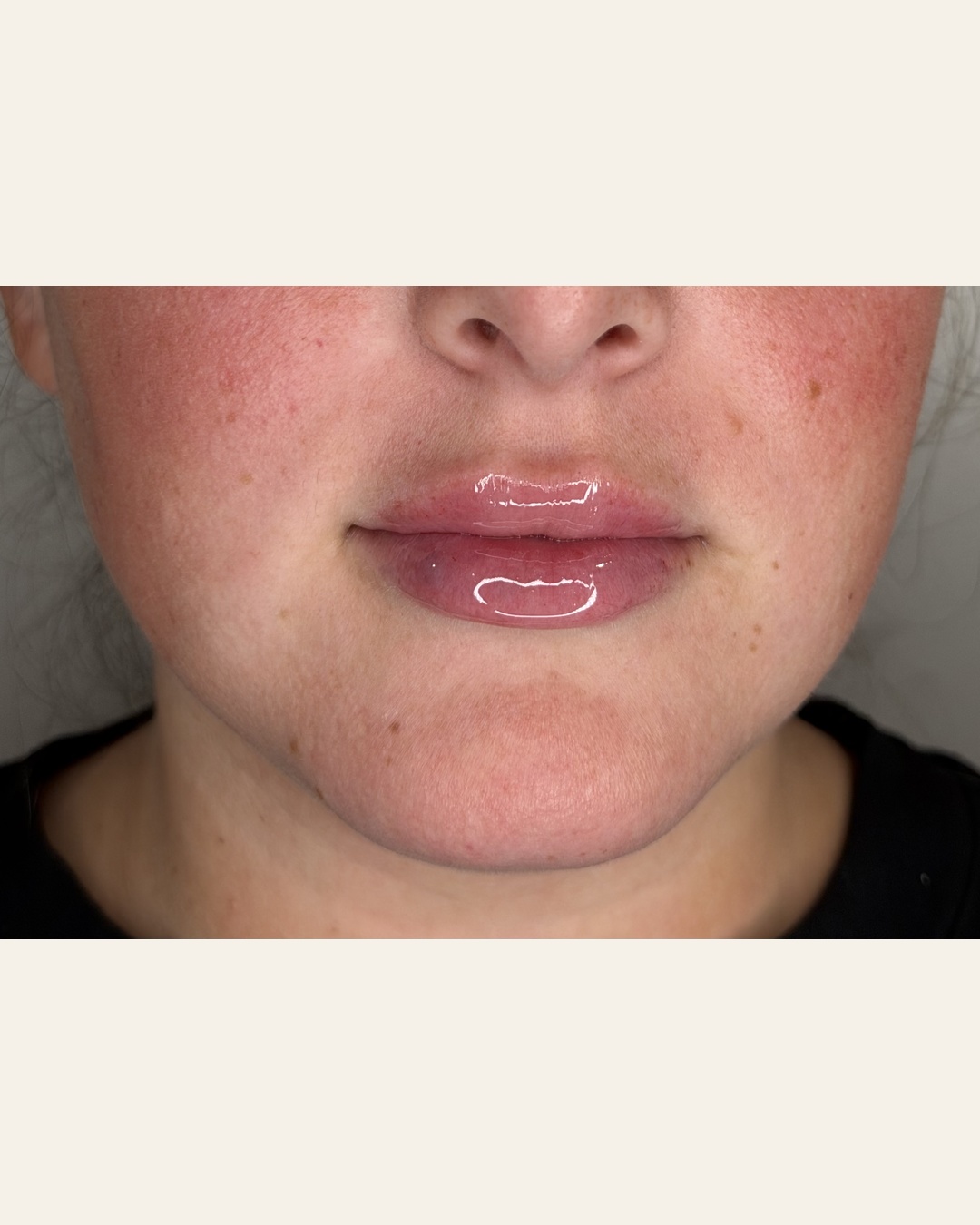 Lip filler result front view at Aesthetic Beauty Lab, Apple Valley MN