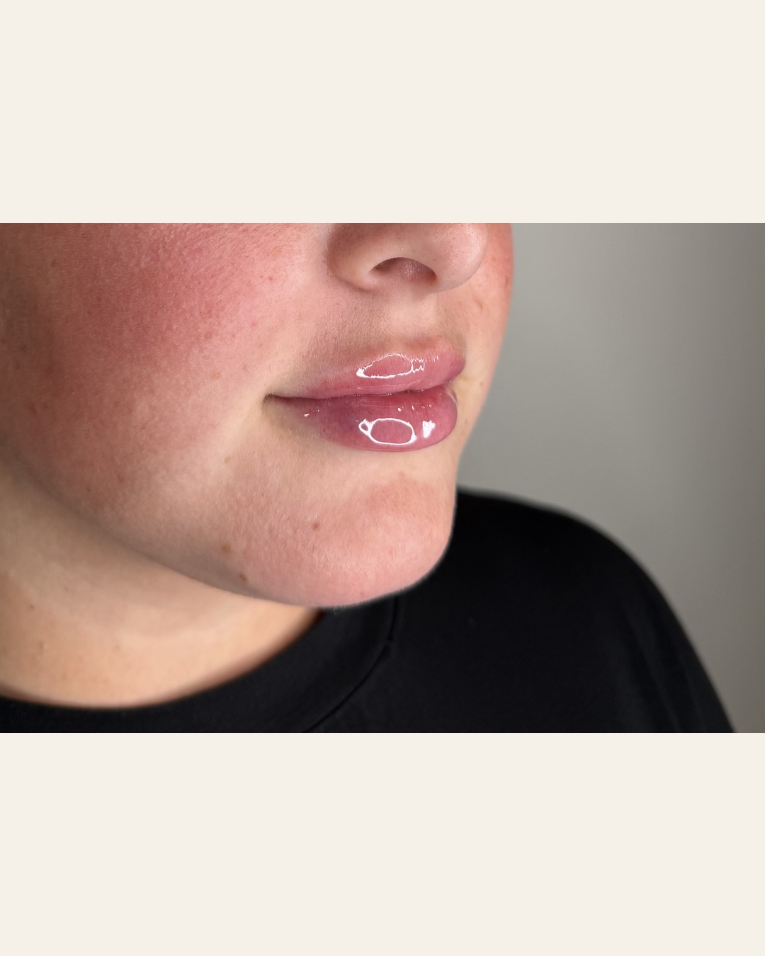Lip filler result side profile at Aesthetic Beauty Lab, Apple Valley MN
