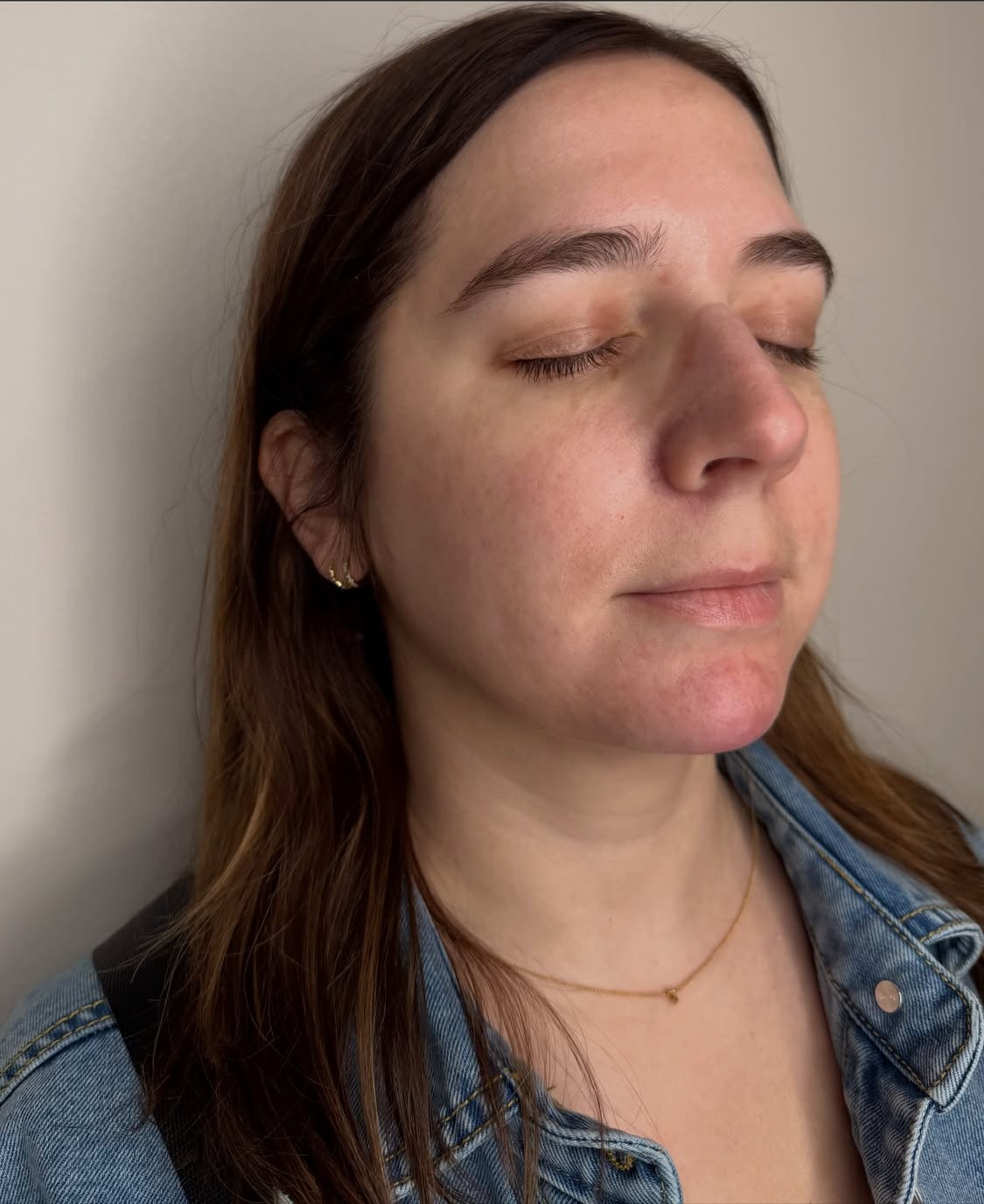 Chin filler result three-quarter view at Aesthetic Beauty Lab, Apple Valley MN