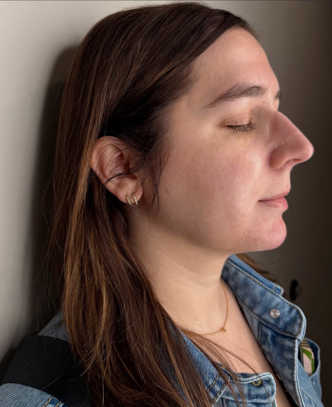 Chin filler result side profile at Aesthetic Beauty Lab, Apple Valley MN