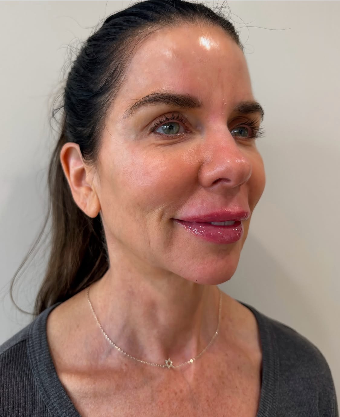 Lip filler result three-quarter view at Aesthetic Beauty Lab, Apple Valley MN