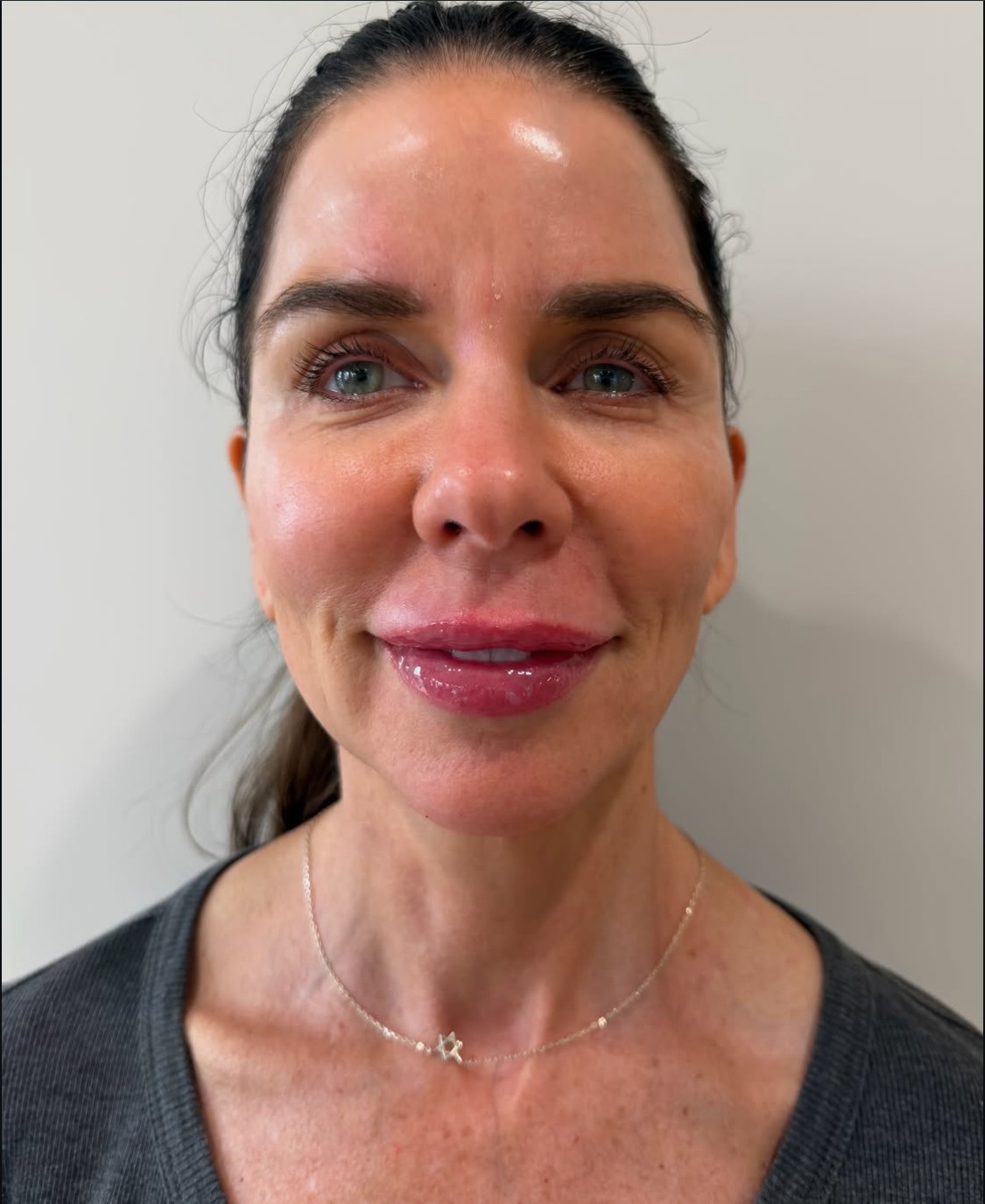 Lip filler result front view at Aesthetic Beauty Lab, Apple Valley MN