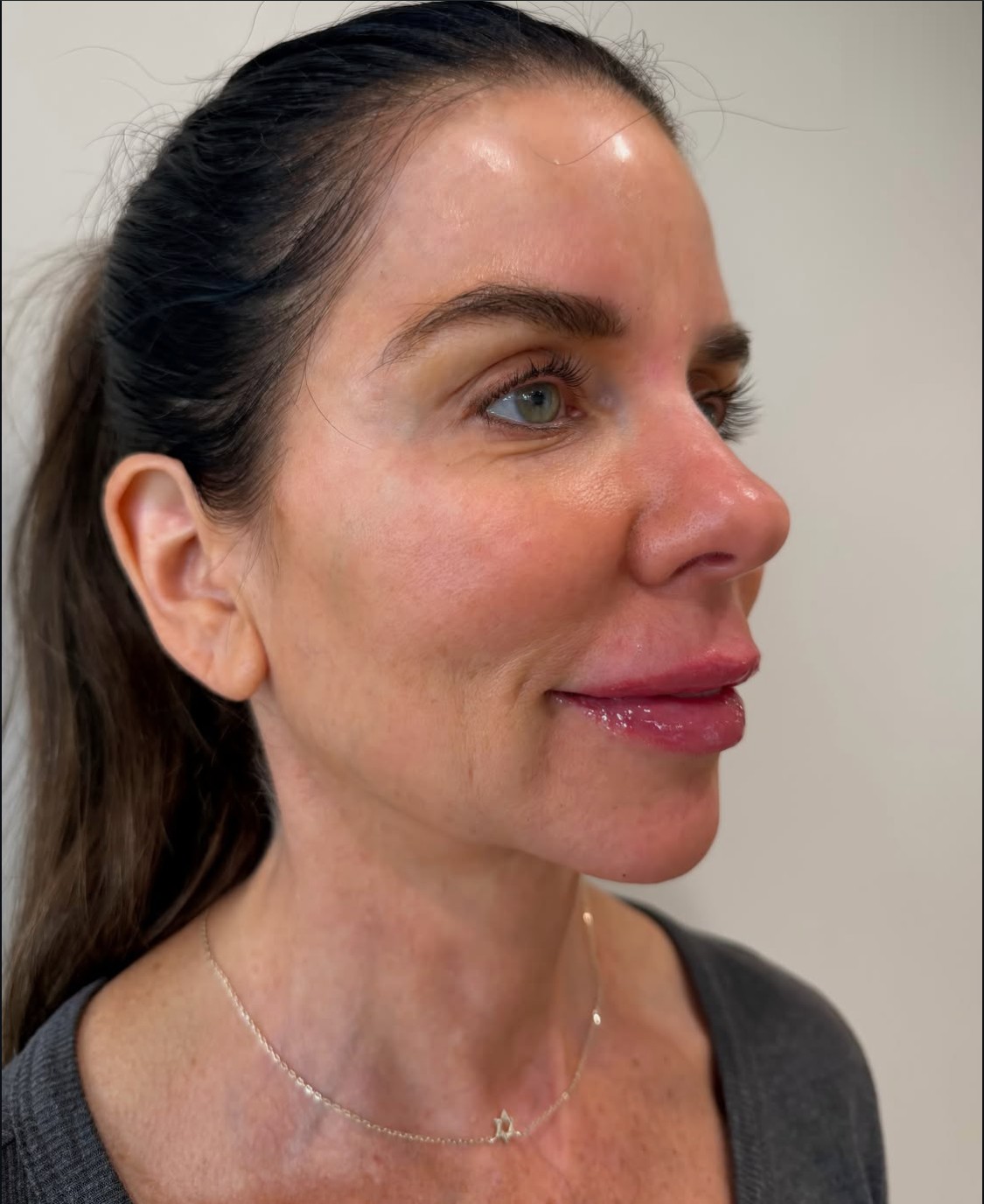 Lip filler result side profile at Aesthetic Beauty Lab, Apple Valley MN